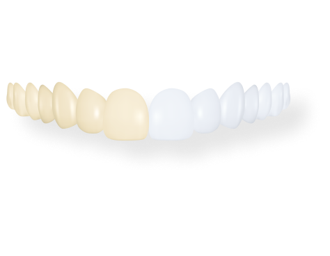 Before and after design of teeth whitening.