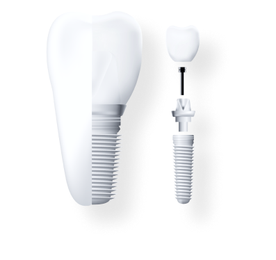 a dental implant