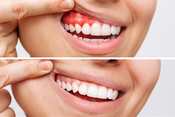 healthy gums vs gum disease
